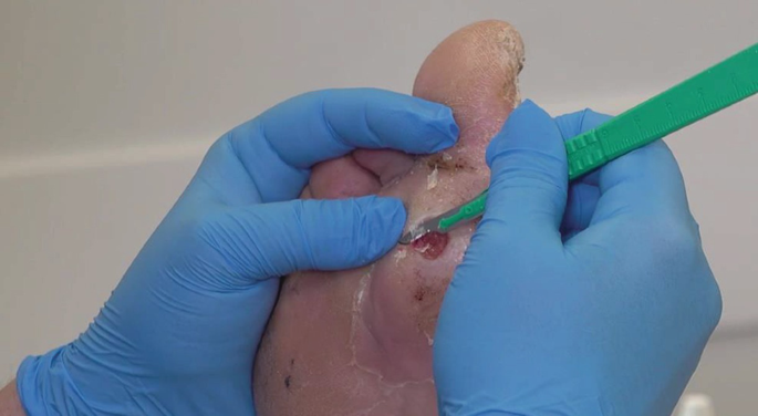 Conservative Sharp Wound Debridement: Clinical Practice Guidelines, Safety, and Procedure Overview