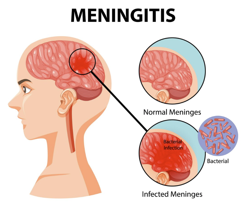 Bacterial Meningitis & Related CNS Infections: Clinical Recognition, Diagnosis, and Management