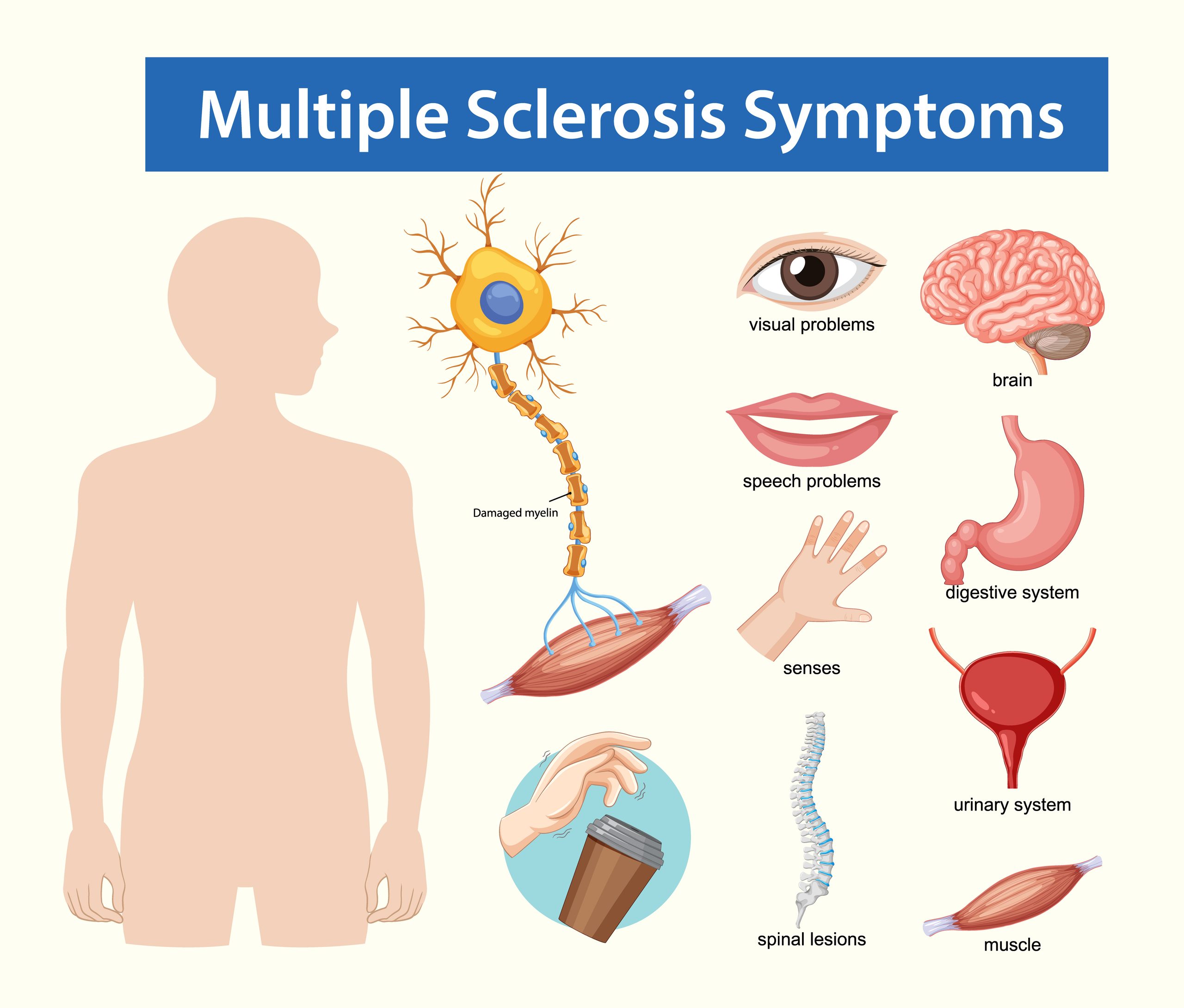 Multiple Sclerosis (MS): Clinical Recognition, Diagnosis, and Management